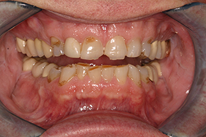 Full Mouth Reconstruction Before Photo